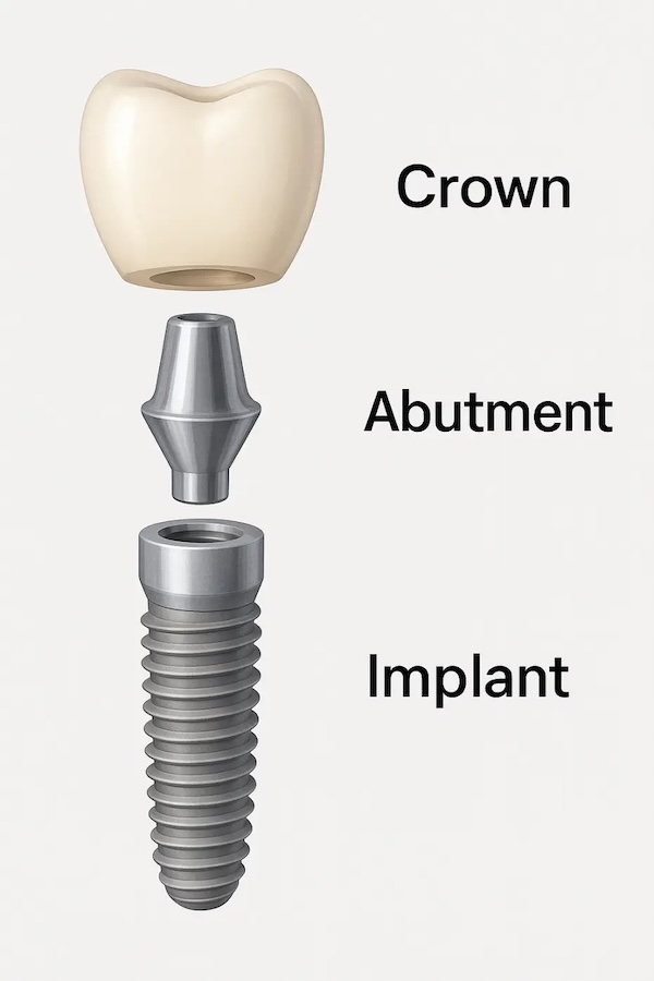 Dental implants in Tampa, FL